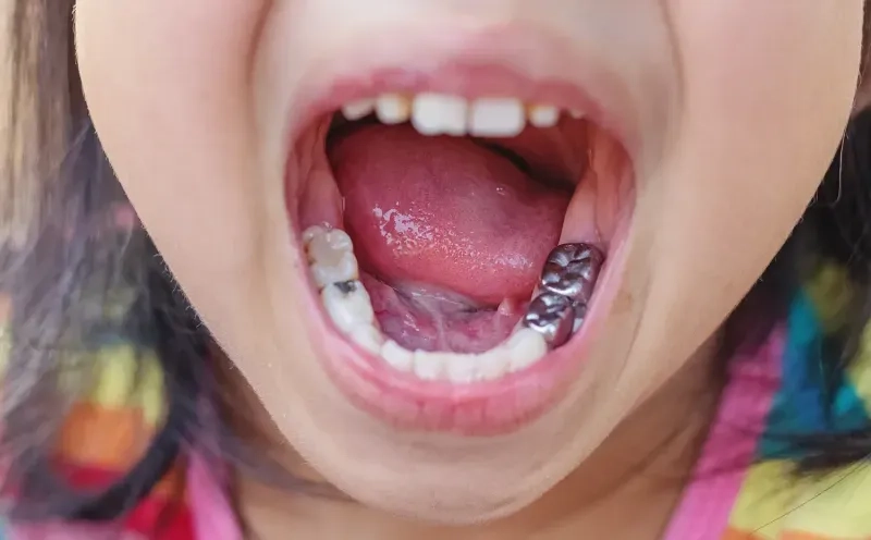 Why Should I Choose Dental Crowns for My Child