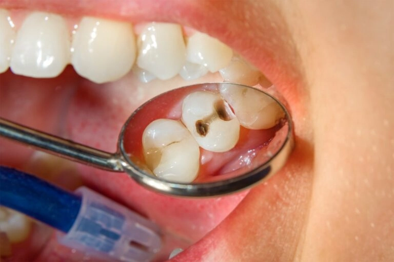 Why Should I Choose Pediatric Cavity Treatment for My Child