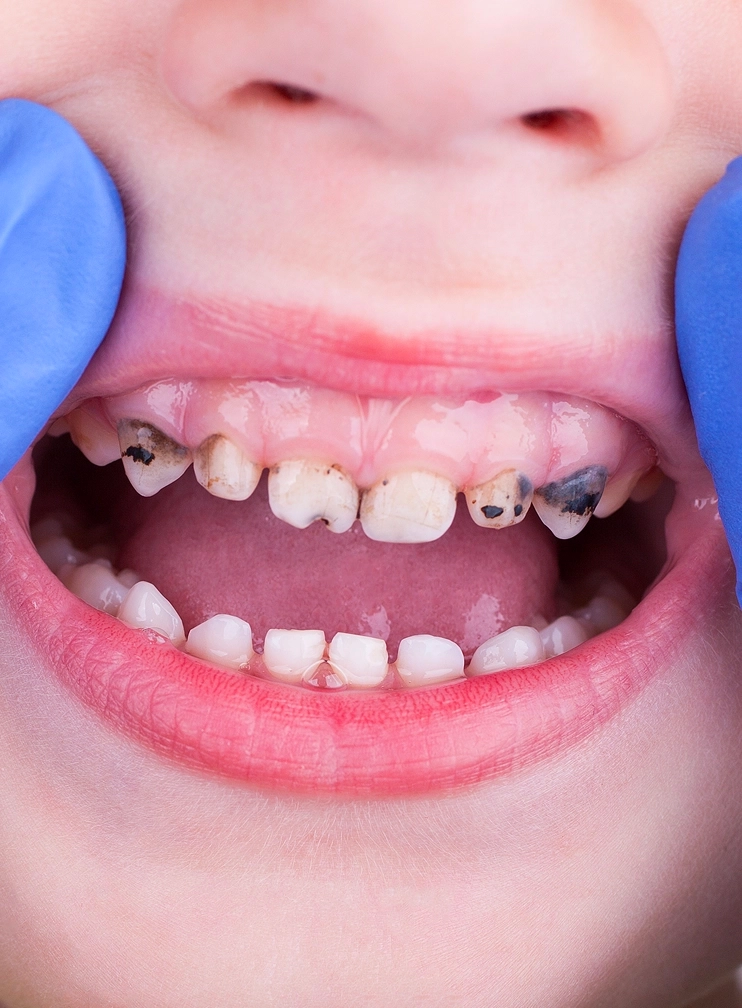 Why Should I Choose Silver Diamine Fluoride for My Child