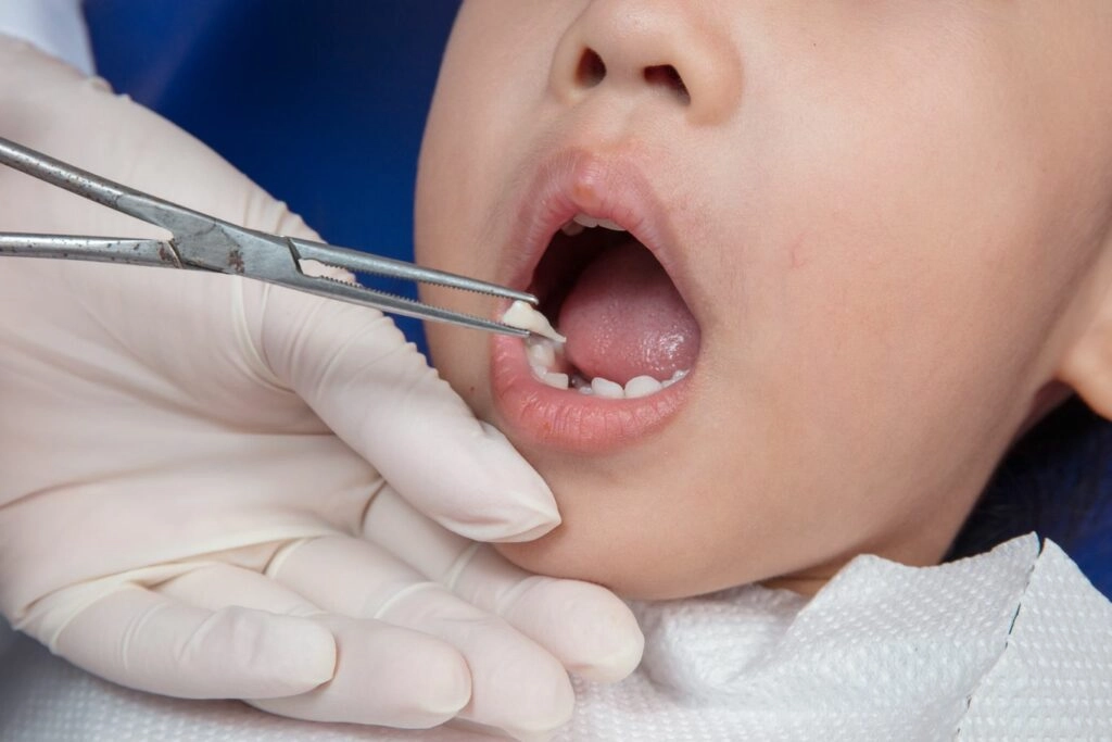 Why Should I Choose Tooth Extraction for My Child