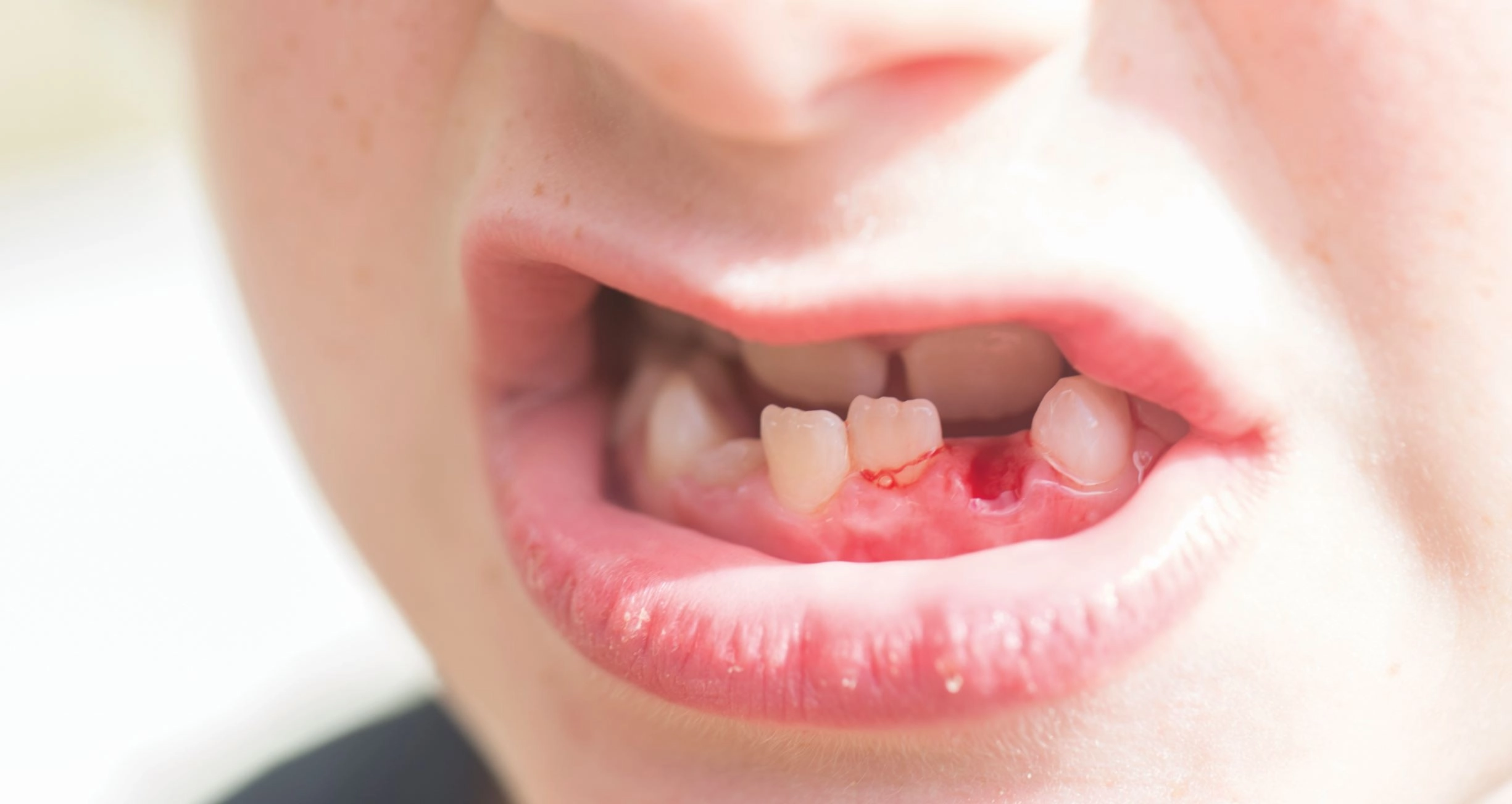 Why Should I Seek Immediate Care for a Knocked-Out Tooth (Avulsed Tooth)