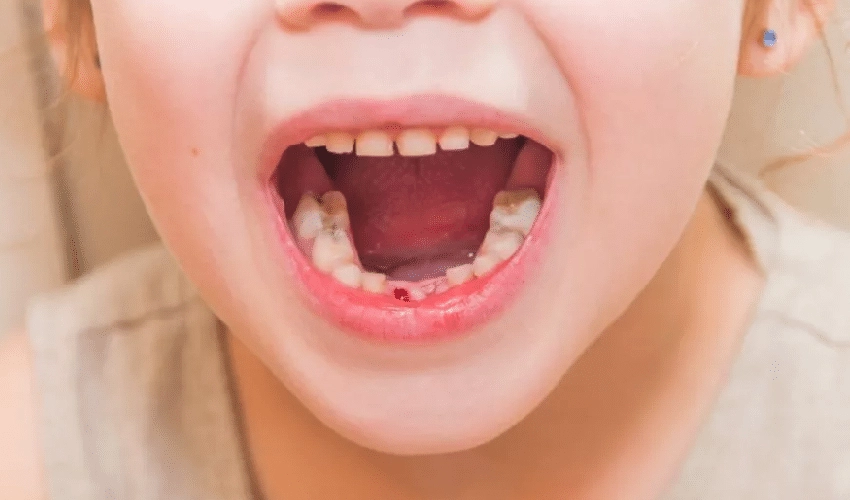 Why Should I Seek Treatment for Gingivitis