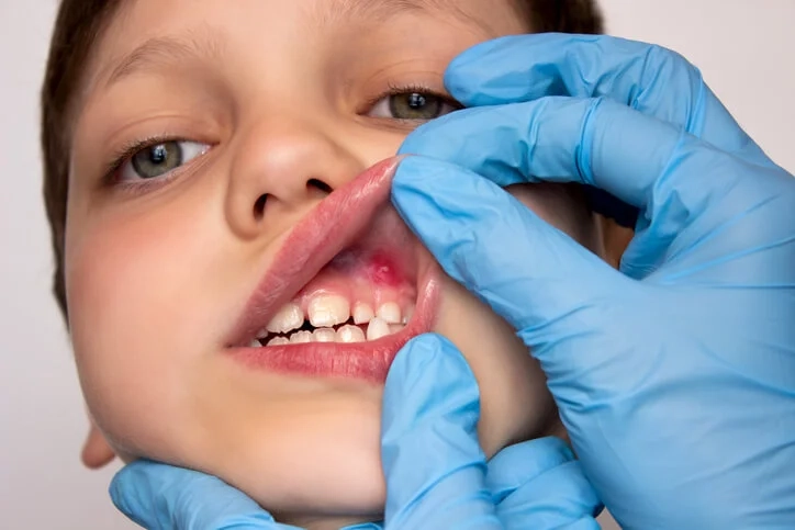 Why Should I Seek Treatment for My Childs Gum Laceration